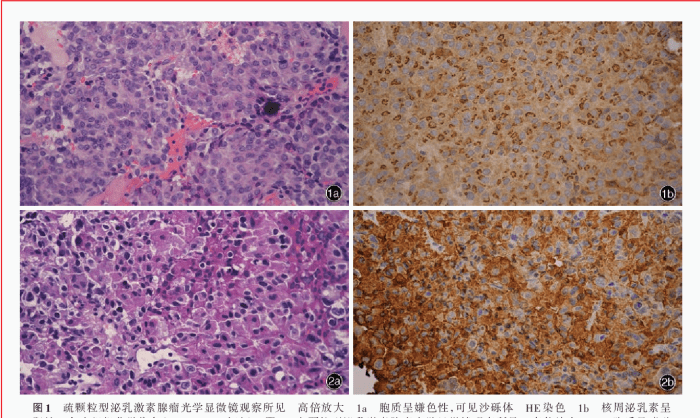 Prolactinoma immunohistochemistry prolactin producing cell fibrous conspicuous tumor confirmed adenoma atypical morphology pituitary spindle fig