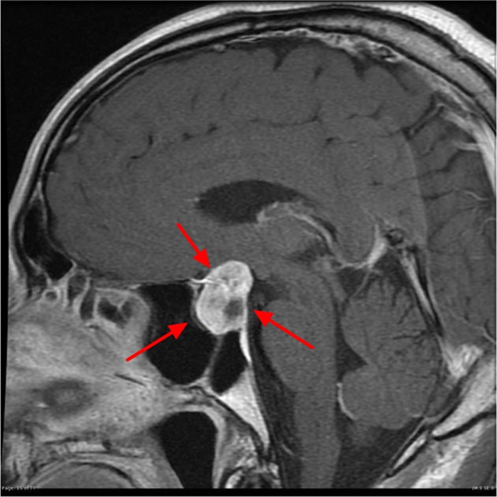 The root in the term prolactinoma means